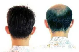 秃头真的治不好吗？图片
