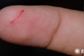 手指被纸割伤 一个小伤口却疼到撕心裂肺 为什么？图片