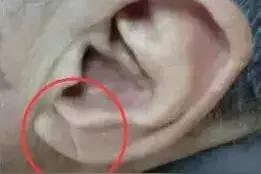 封面心脏专家告诉你藏在耳垂里的秘密图片