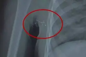 体温计破裂竟使3岁女孩体内残留水银！你的体温计使用正确了吗？图片