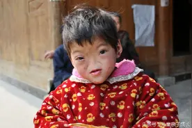 小女孩先天性无鼻畸形症，导致畸形的原因原来是这个图片