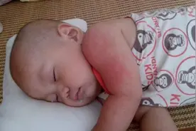 婆婆夏天坚决不给宝宝开空调，竟害宝宝长满了痱子！图片