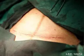 我把我剖腹产的过程记录了下来图片