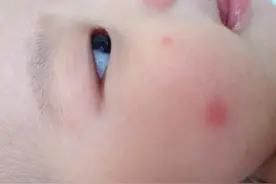 孩子被蚊子叮咬了怎么办，有这8招可快速止痒消肿图片