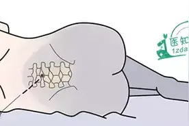 无痛分娩：真的无痛吗？会影响分娩时用力吗？图片