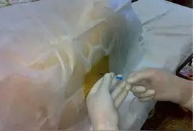 看了准妈妈剖腹产全过程之后觉得她们是世上最伟大的。图片
