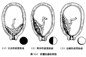 孕妈别懊恼：大多数胎盘前置无需治疗，自会好转图片