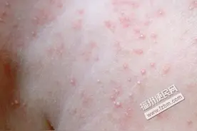 高温天气，热出了痱子怎么办？图片