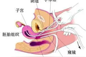 无痛人流是怎么进行的图片