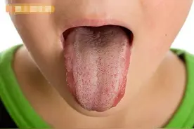舌头藏健康学问！舌苔厚薄原来是...图片