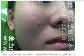 脸上疤痕如何彻底修复图片