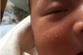 宝宝脸上有小米粒似的东西检查是湿疹，治疗及预防宝宝湿疹的方法图片