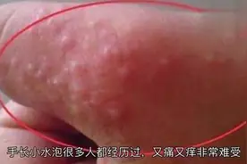 手长小水泡不要怕，教你个土偏方，止痒快还能让水泡消失后不留疤