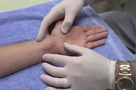 近距离实拍大妈做激光去疤，阵阵激光打在手上，有种被烤焦的感觉视频封面