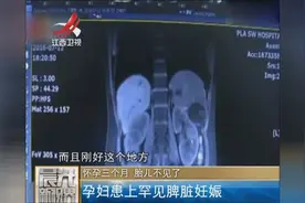 神奇！怀孕三个月，检查出胎儿长在肝脏上！图片