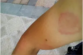 不要以为宝宝身上起红印是小事，一不留神可能会害了宝宝一生！图片