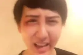 蛇精男刘梓晨被打的鼻青脸肿假体都歪了 网友：我要给英雄送锦旗图片