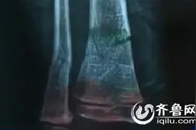 临沂4岁男童幼儿园摔骨折 校方垫付医药费后遇难题图片