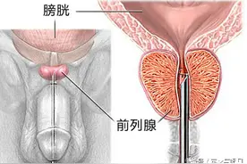 男性前列腺肥大问题，竟也暗藏家庭危机！图片