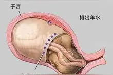 临产征兆——"破水"需小心图片