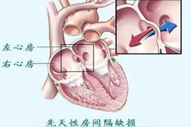超声收藏| 房间隔缺损的鉴别诊断图片