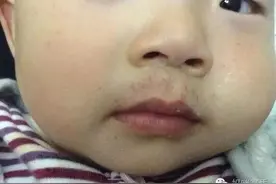 女孩长出红色“胡子”，不是激素引起而是因为一个小动作图片