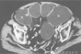 影像学征象-鸟嘴征图片