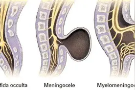 关于隐性脊柱裂，你想知道的都在这儿图片