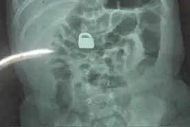 两个月宝宝被两岁哥哥塞平安锁！孩子误食异物爸妈要这样做图片