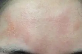 折腾了宝宝两个月的湿疹，终于找到原因了图片