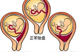 求神问卜不及医学帮助，孕期必须当心的胎盘前置问题！图片