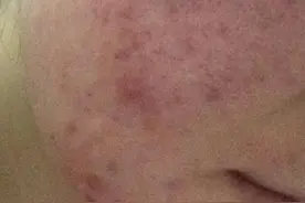 你知道鼻子长痘痘的原因吗？祛痘食谱可以帮你！图片