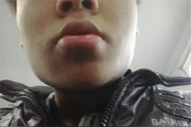 唇炎老是不好，口角唇炎怎么办？图片