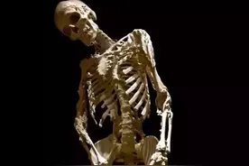 罕见的石人综合症（必点收藏）图片