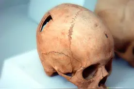 古印第安人的另类手术“穿颅取骨术”图片