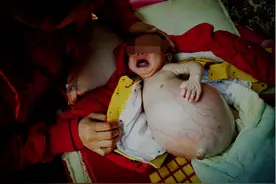 4月大女婴患恶性肿瘤晚期 腹部肿大如足球图片