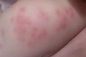 揭秘宝宝过敏怎么破？图片