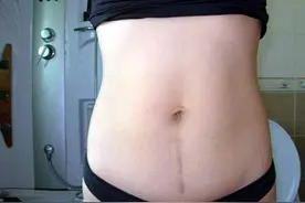 剖腹产的妈妈们想产后不留疤吗？这样护理伤口准不留!图片
