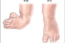 足内翻用什么方法治疗比较好图片