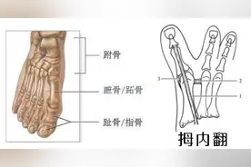 观察细微变化  轻松应对拇内翻的症状图片