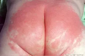 宝宝出现红屁股，如何正确应对？图片