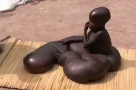 非洲男孩得怪病腿长1.5米打破医学记录，医生束手无策。图片