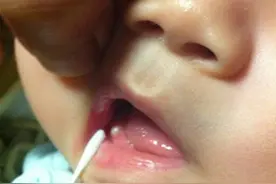 宝宝牙板上的黄白色小点是怎么回事图片