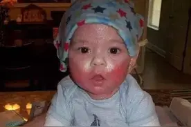 湿疹并不是简单的皮肤病！图片