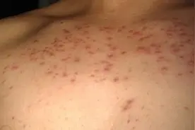 为什么胸前总是长痘痘？图片