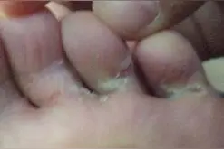 脚气有哪些危害，让脚气远离孕妇的妙招图片