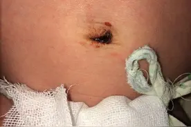 育儿爸妈必看！宝宝出生四周脐炎去世！新生儿护理不是你想的那么简单！图片
