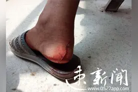 真疼！穿拖鞋骑电动车 宿迁张大爷的脚竟然成了这样图片