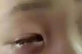 男孩将生石灰干燥剂放水中爆炸 右眼被腐蚀失明图片