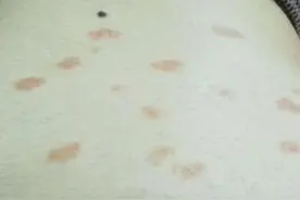 玫瑰糠疹病种知识早知道图片